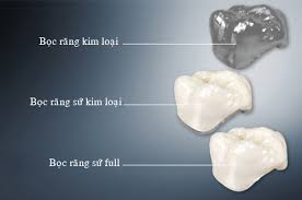 Chụp kim loại thường